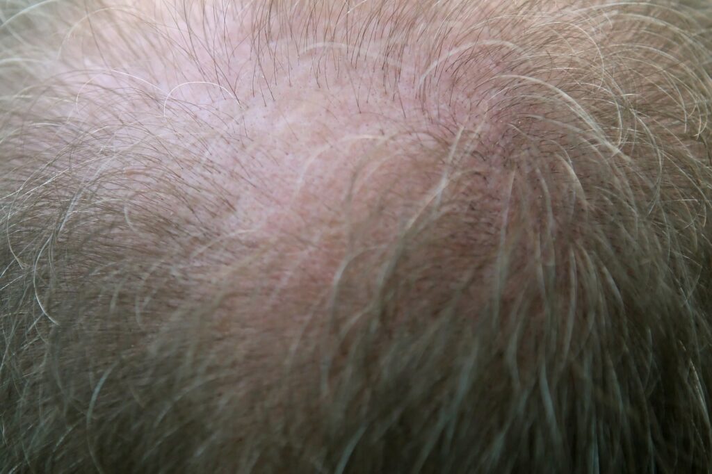 Cura Alopecia Bazzano