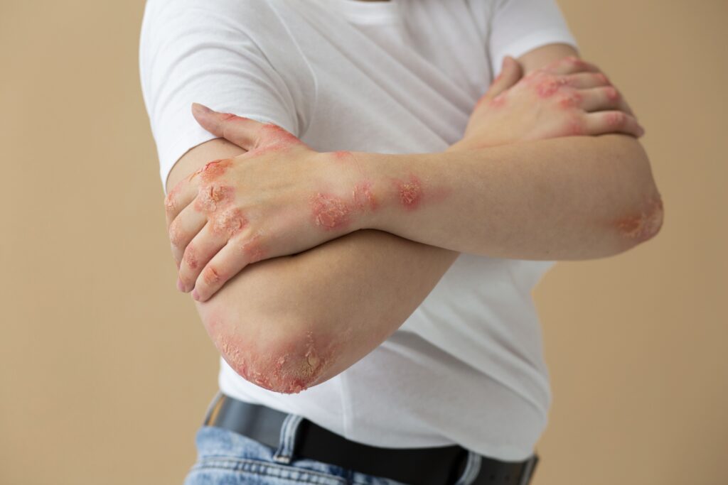 Dermatite Atopica Bazzano