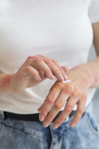 Dermatite Atopica Pieve di Cento