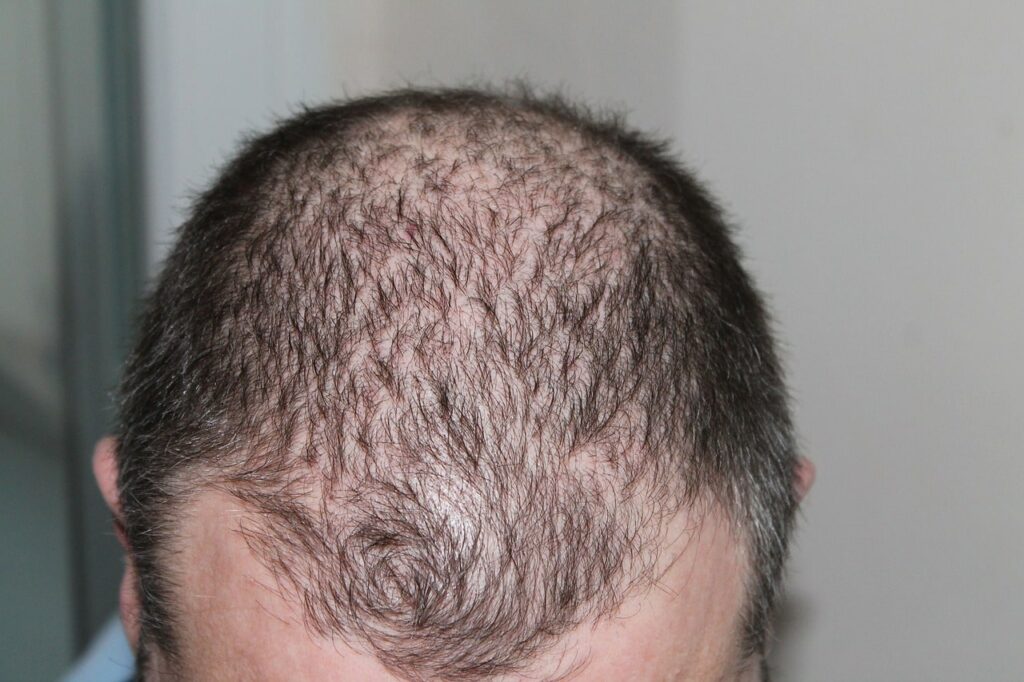 Cura Alopecia Granarolo